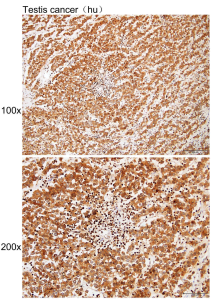 Immunhistochemie von in Paraffin eingebettetem menschlichem Hodenkrebs mit ALPPALPGALPI-Antikörper verdünnt bei 180