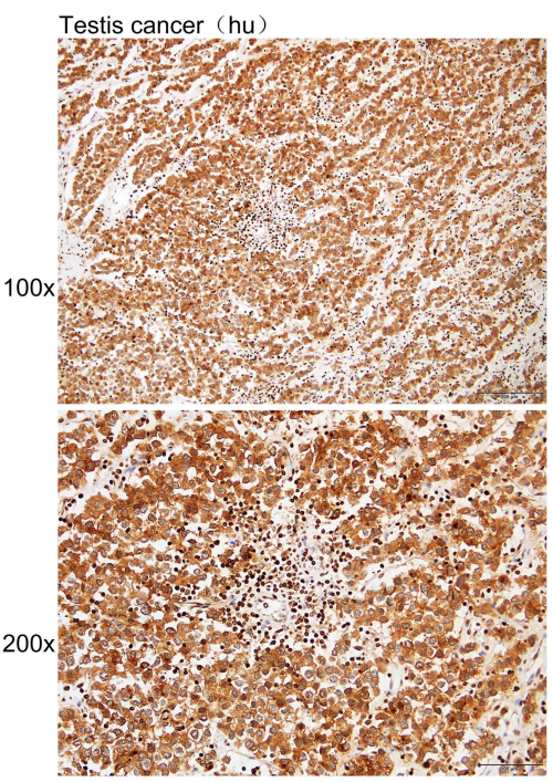 Immunhistochemie von in Paraffin eingebettetem menschlichem Hodenkrebs mit ALPPALPGALPI-Antikörper verdünnt bei 1 Zu 180