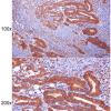 Immunohistochemistry of paraffin-embedded Human colorectal cancer with APOOL antibody diluted at 1:100